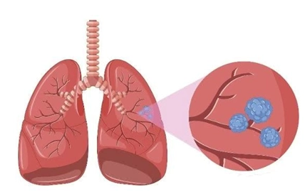 肺部有结节是怎么回事？要紧吗？我们应该谨慎判断