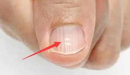 指甲有竖纹是身体的什么信号？注意啦，这是你身体发出的警告