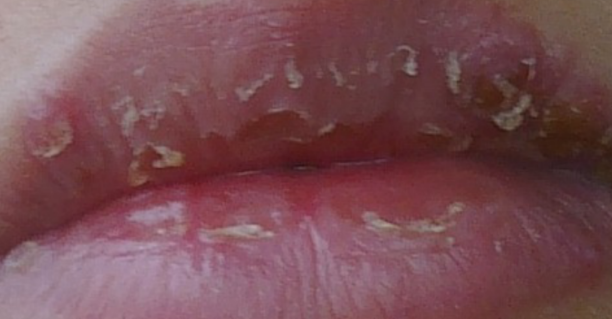 嘴唇干裂起皮什么原因造成的？一文详解，嘴唇干裂的原因