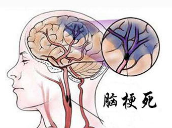 脑梗的症状都有哪些前期症状，脑梗塞有什么征兆表现